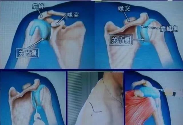 关节穿刺各关节腔穿刺方法技巧大全