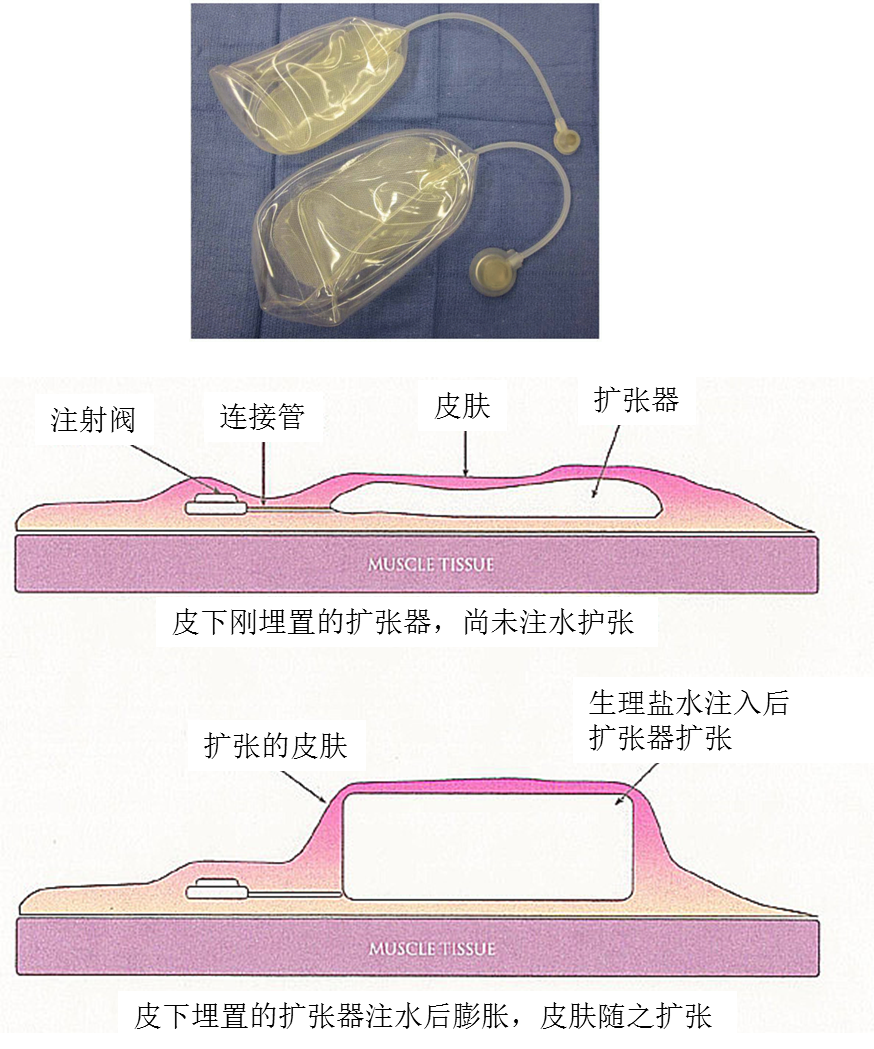 乳腺扩张器图片