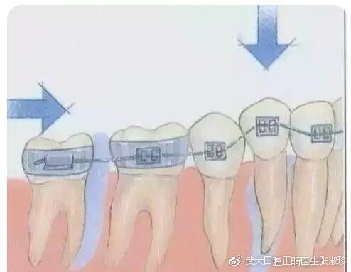 牙齿矫正的原理,原来牙套是这样移动的!