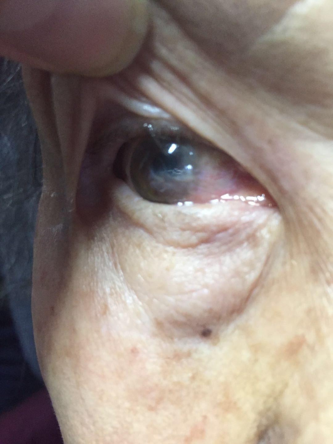 一上来就说她奶奶得了白内障,一个眼睛0