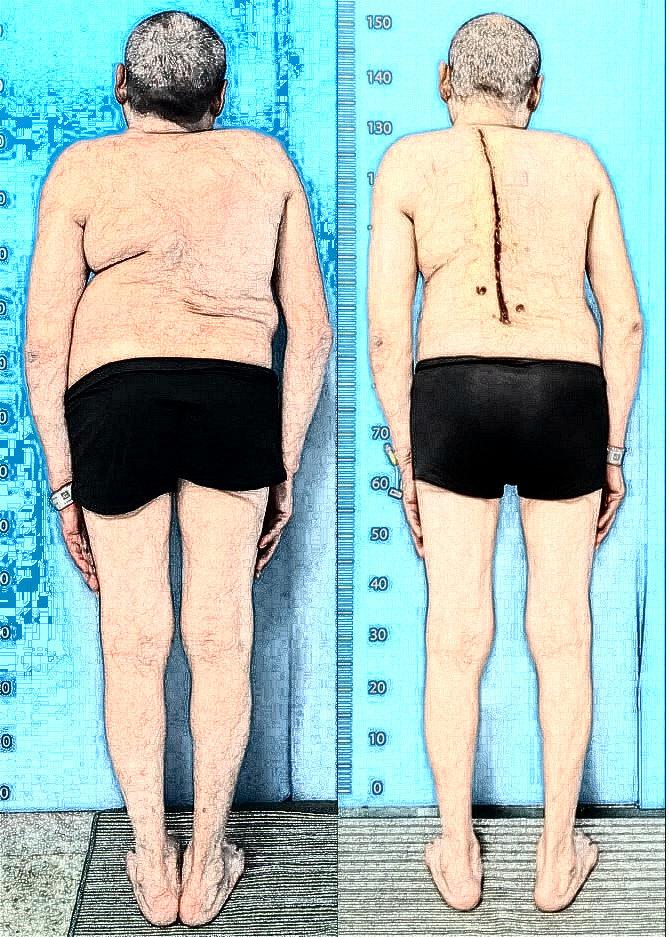 背部不平要小心宰相刘罗锅治疗记