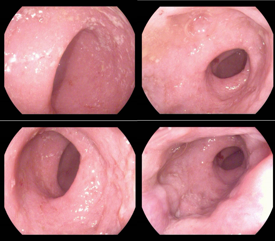 青玉散愈合5年慢性复发型直肠型溃疡性结肠炎患者的肠道