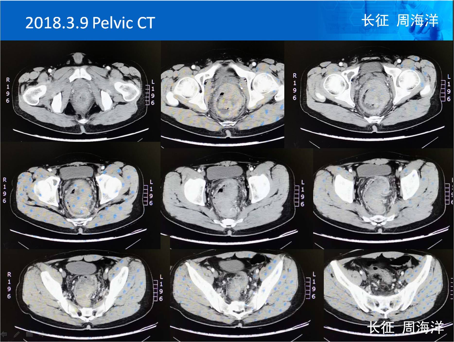 及局部放疗,治疗后盆腔ct如下,最终完成腹腔镜直肠癌根治术(保肛低位