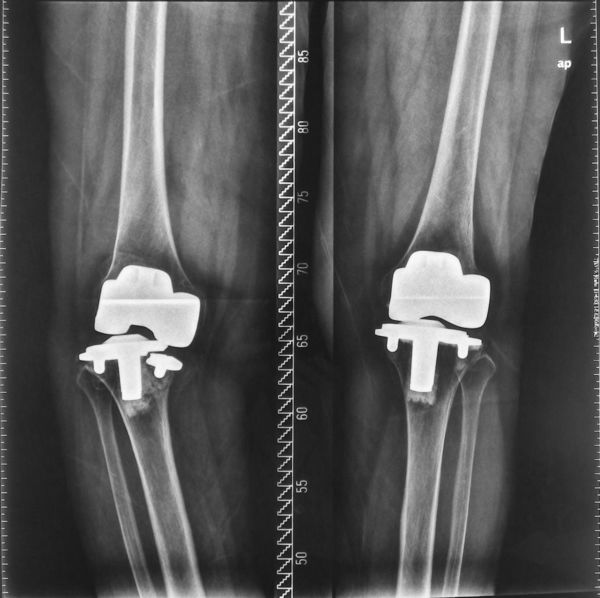 高难度手术之七膝关节置换术后假体松动