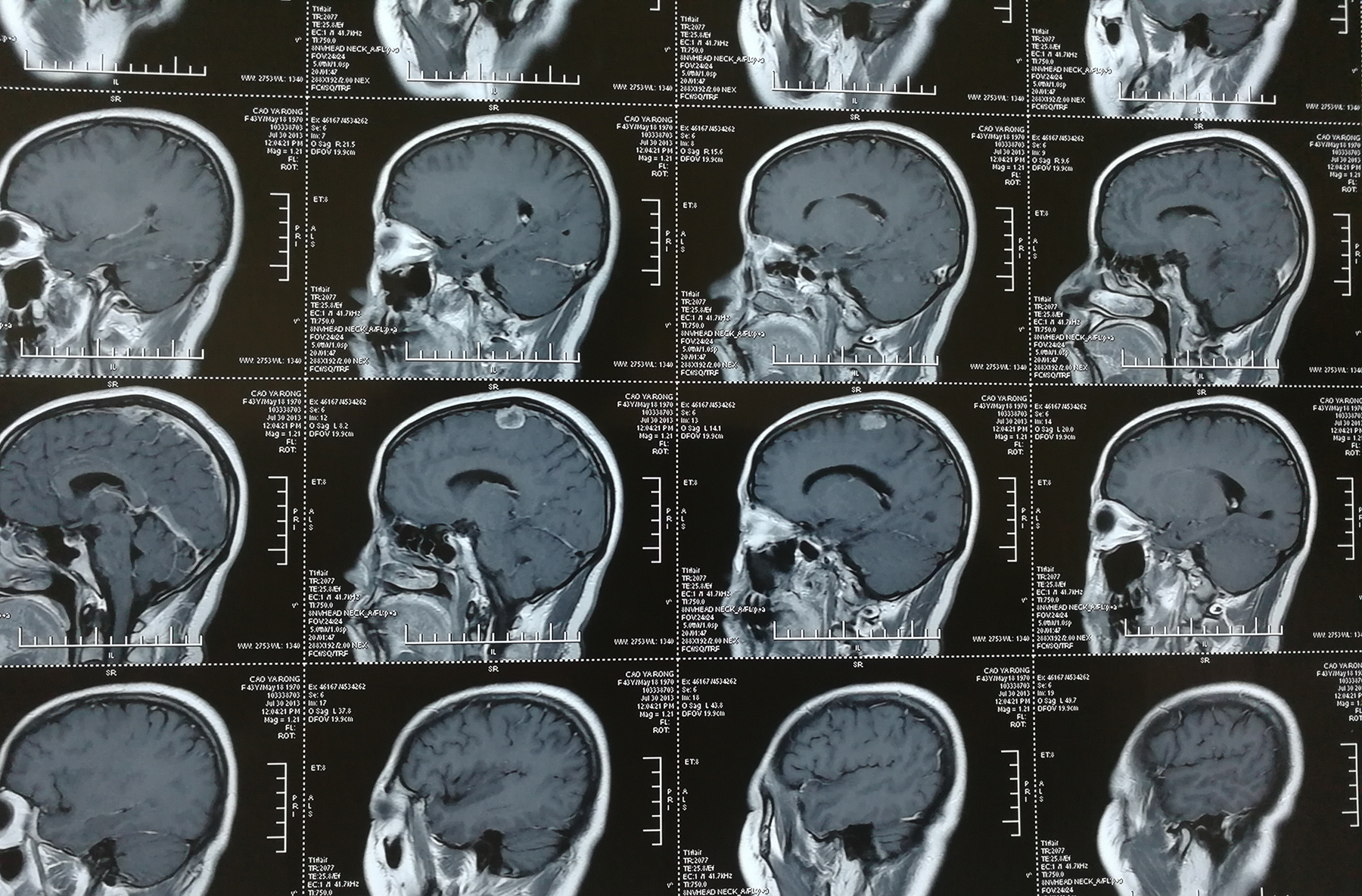 贺晓生教授脑膜瘤治疗案例展示图例