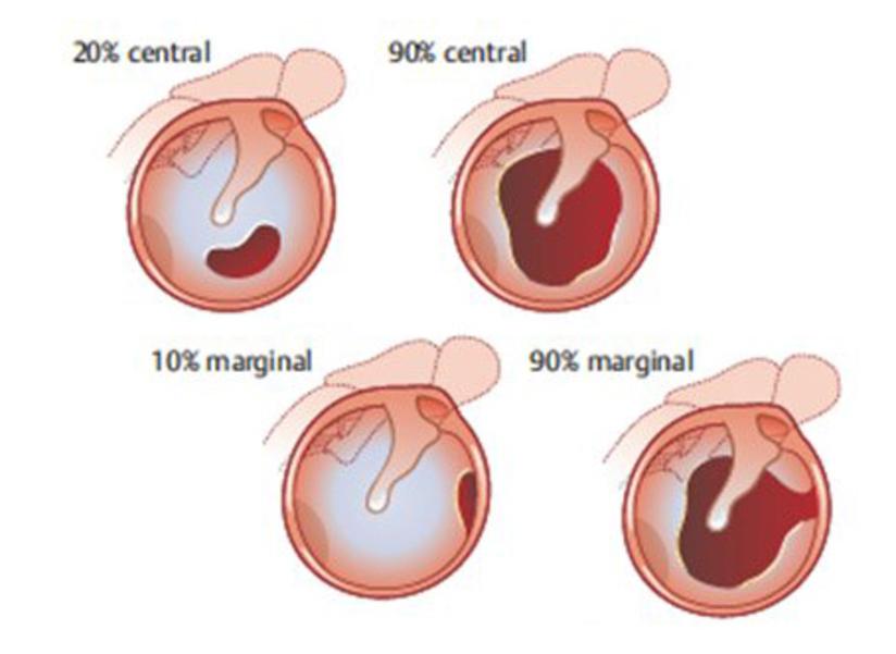 鼓膜穿孔了该怎么办 健康号 微医