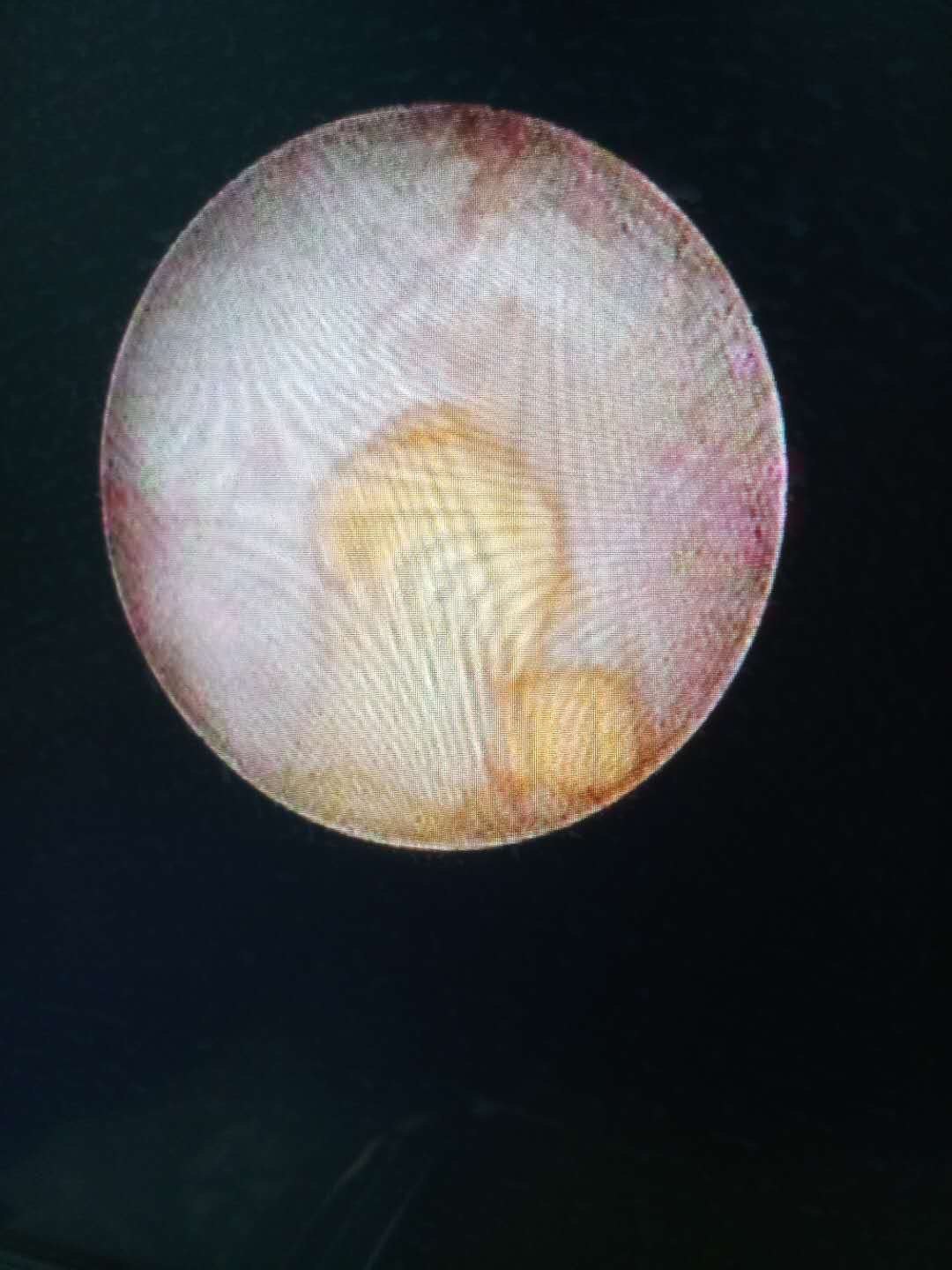 精囊镜治疗血精精囊结石