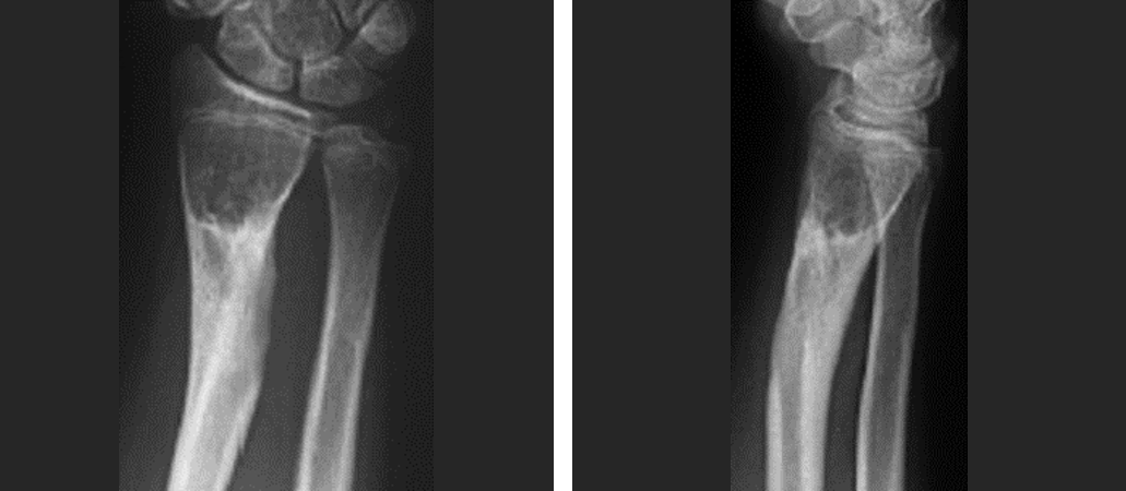 腕关节骨折(桡骨远端) - 微医(挂号网)