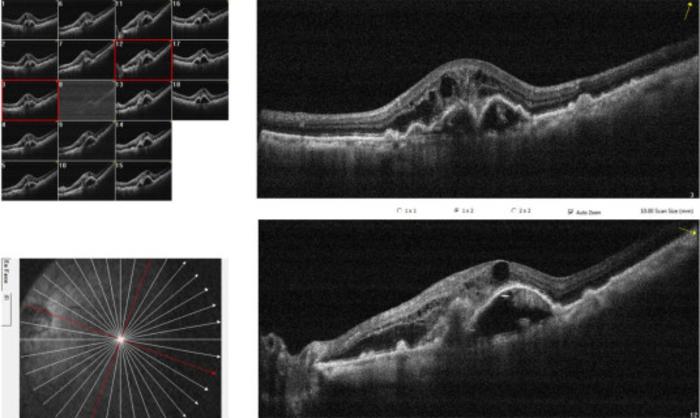 眼底照相及oct扫描图像:干性年龄相关性黄斑变性年龄相关性黄斑变性