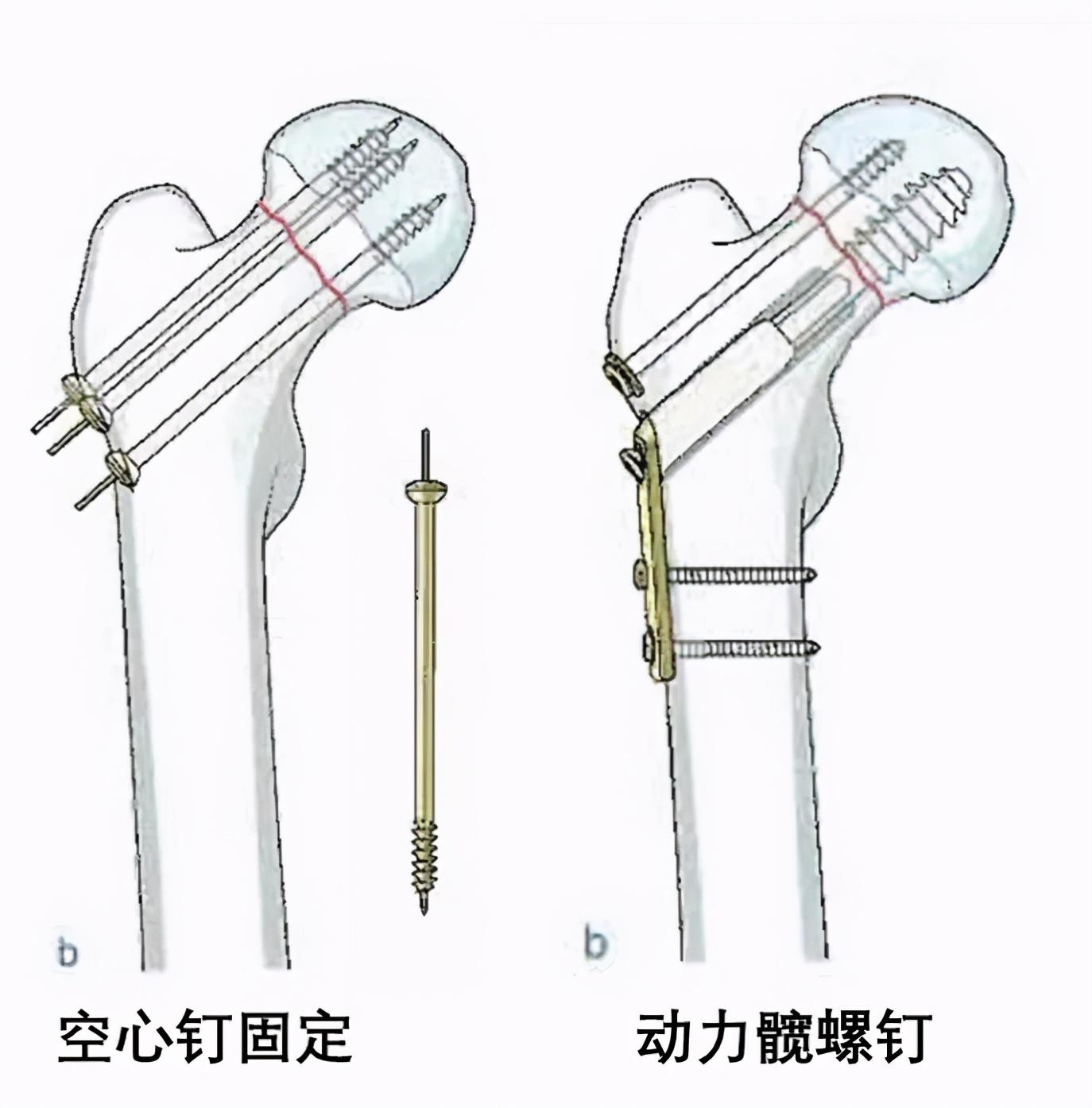 老年髋部骨折人生最后一次骨折一股骨颈骨折