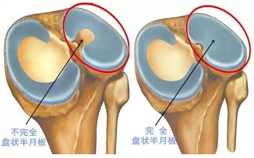 膝关节半月板损伤的原因 健康号 微医