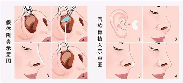 同样是自体软骨,耳软骨与肋软骨各有哪些优缺点