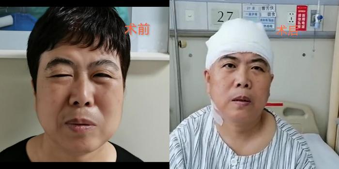【病例-面肌痉挛】显微血管减压术后,面部抽搐终于治好了!