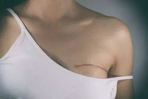 没有肿块  就不会罹患乳腺癌