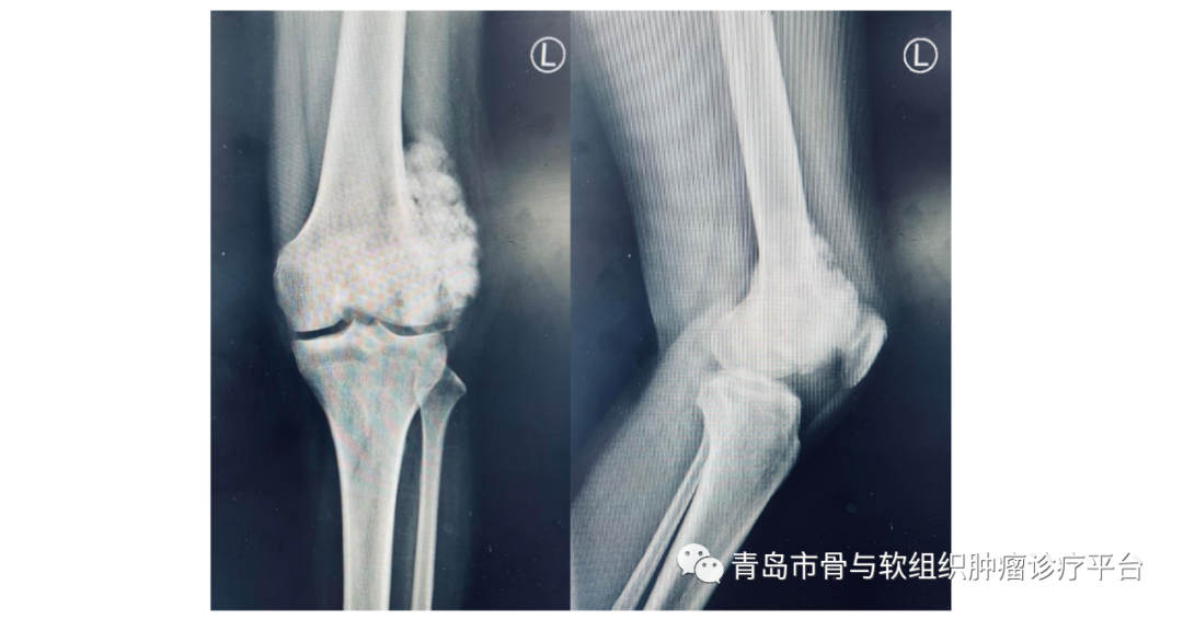 【术前影像学检查】患者近一年病情进展迅速,考虑皮质旁骨肉瘤恶变