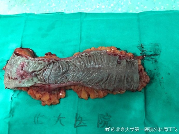 结直肠癌患者术中肠镜的合理利用