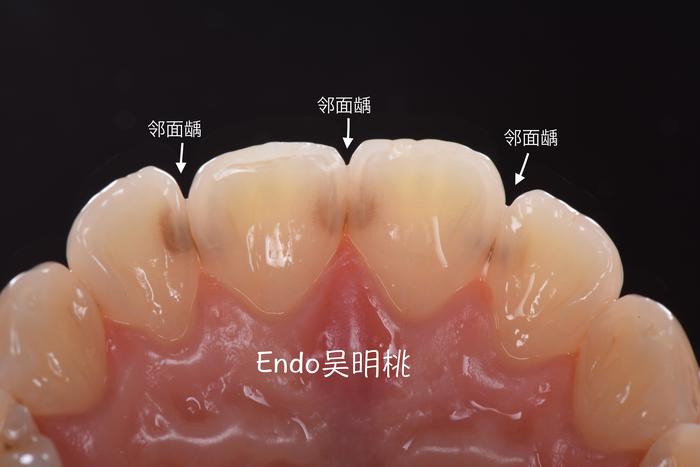从后面看,门牙几乎都蛀了还有些时候,特别是在口腔专科医院,分科比较
