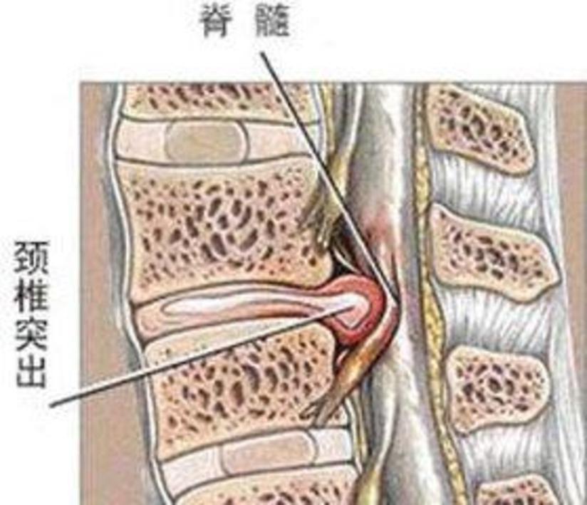 怎样改善颈椎突出 健康号 微医