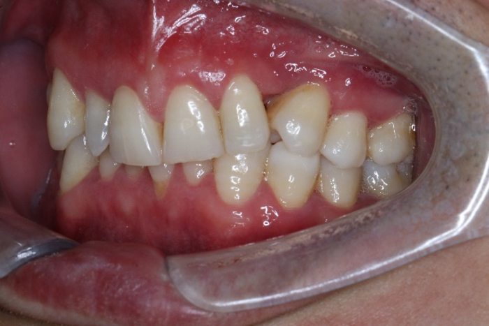 一般来说深覆合分成两种,一种是上前牙唇倾伴前牙深覆盖的深覆合.