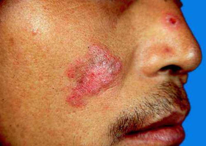 屠呦呦团队青蒿素用于治疗红斑狼疮的前景怎么样?