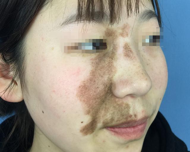 褐色胎记看上去不疼不痒危害却不容小觑!-微医