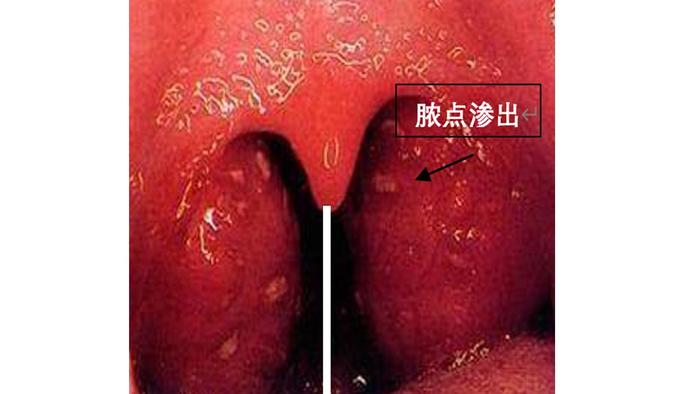 图2 扁桃体一度肿大伴有充血怎么看肿大的程度呢?