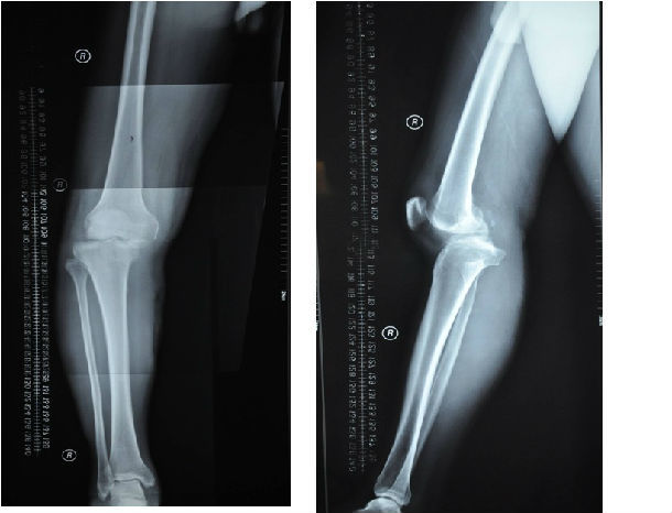 陈旧性不可复性膝关节骨折脱位的外科治疗