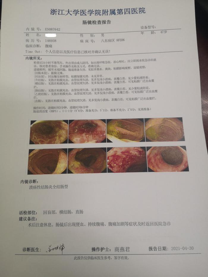 青玉散对于血便脓血便的溃疡性结肠炎疗效确切附近期重度全结肠uc患者