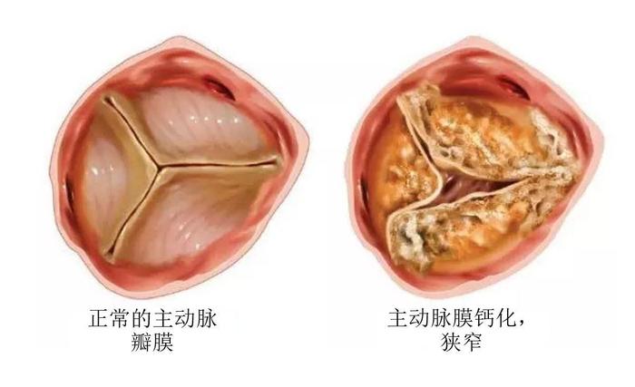 第二种就是主动脉瓣关闭不全.