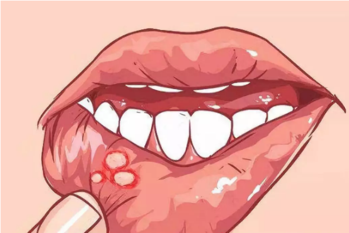 口腔怎么分辨上火还是尖锐湿疣