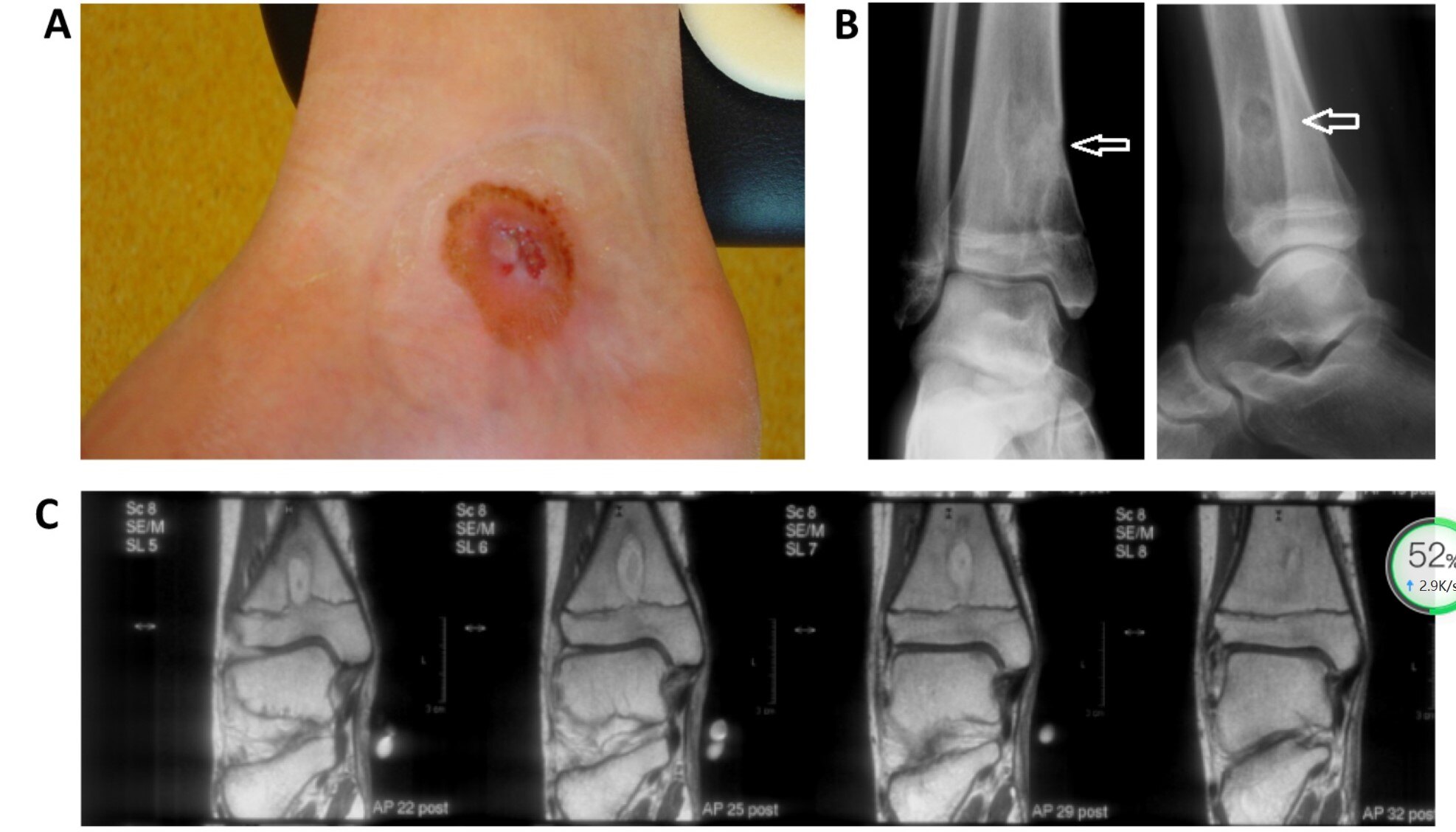 慢性骨髓炎brodie脓肿