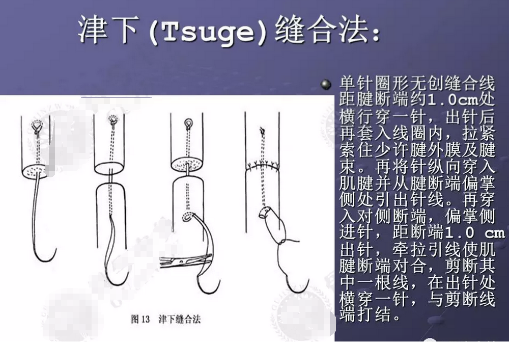 肌腱韧带损伤肌腱缝合的原则和方法汇总