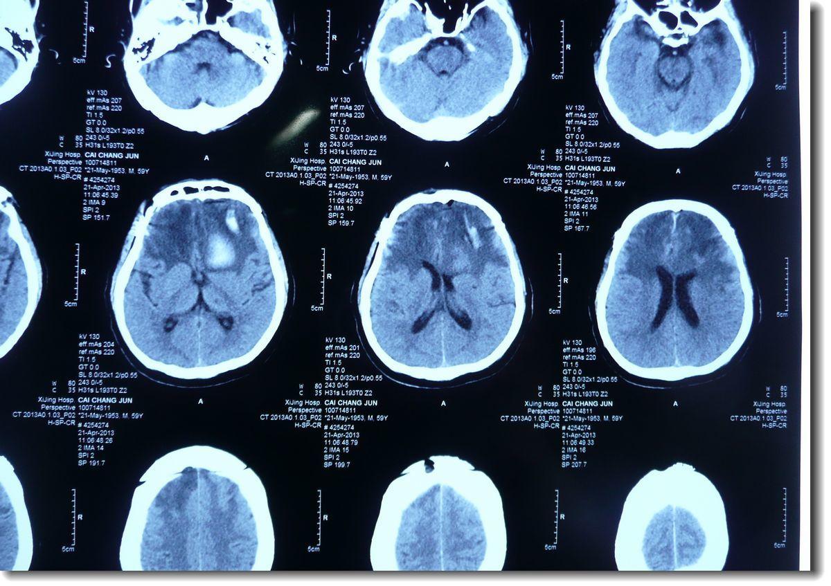 脑瘤图片大全真实,脑瘤检查报告图片大全 - 伤感说说吧