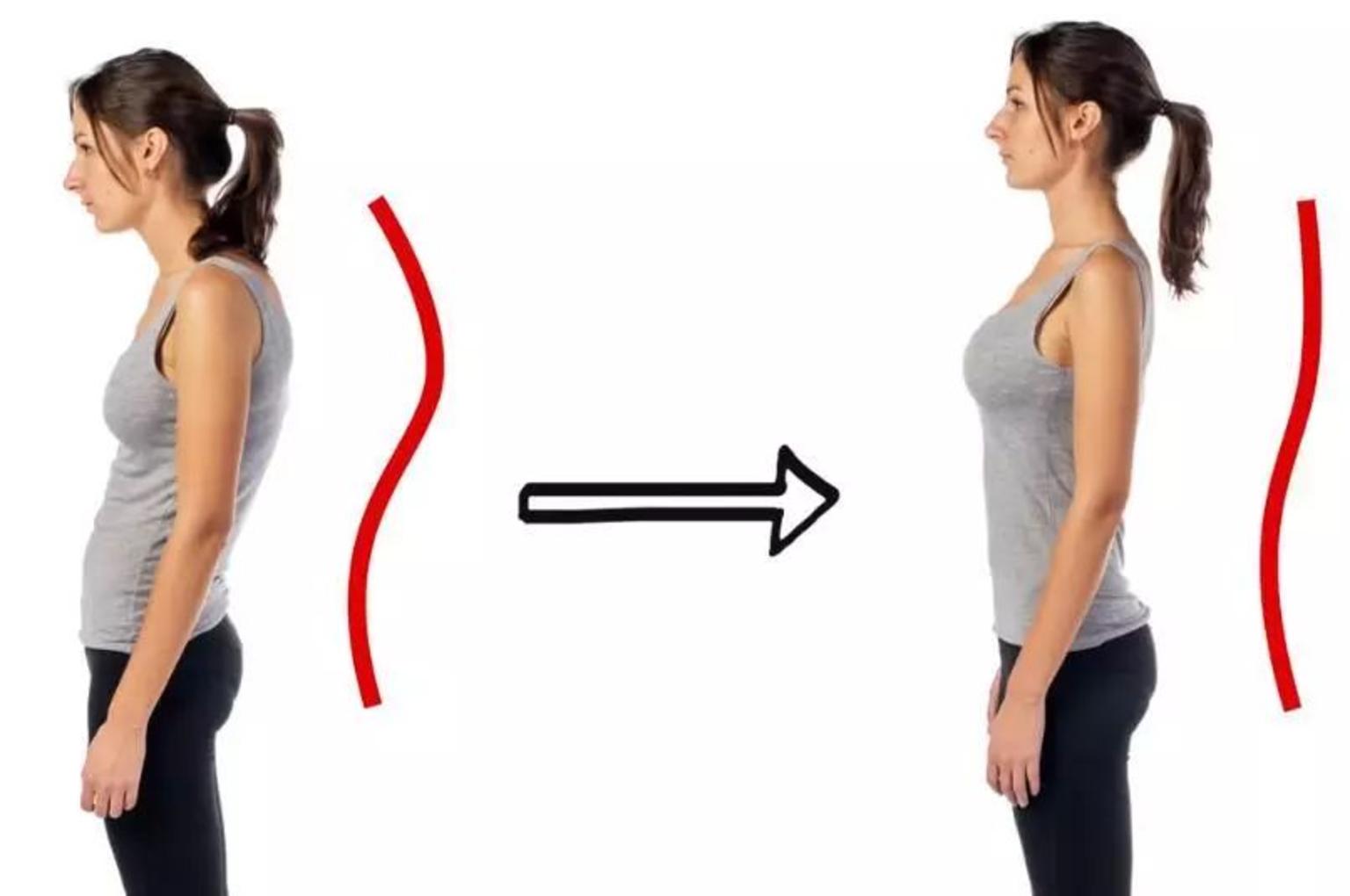 上交叉综合症的康复治疗策略