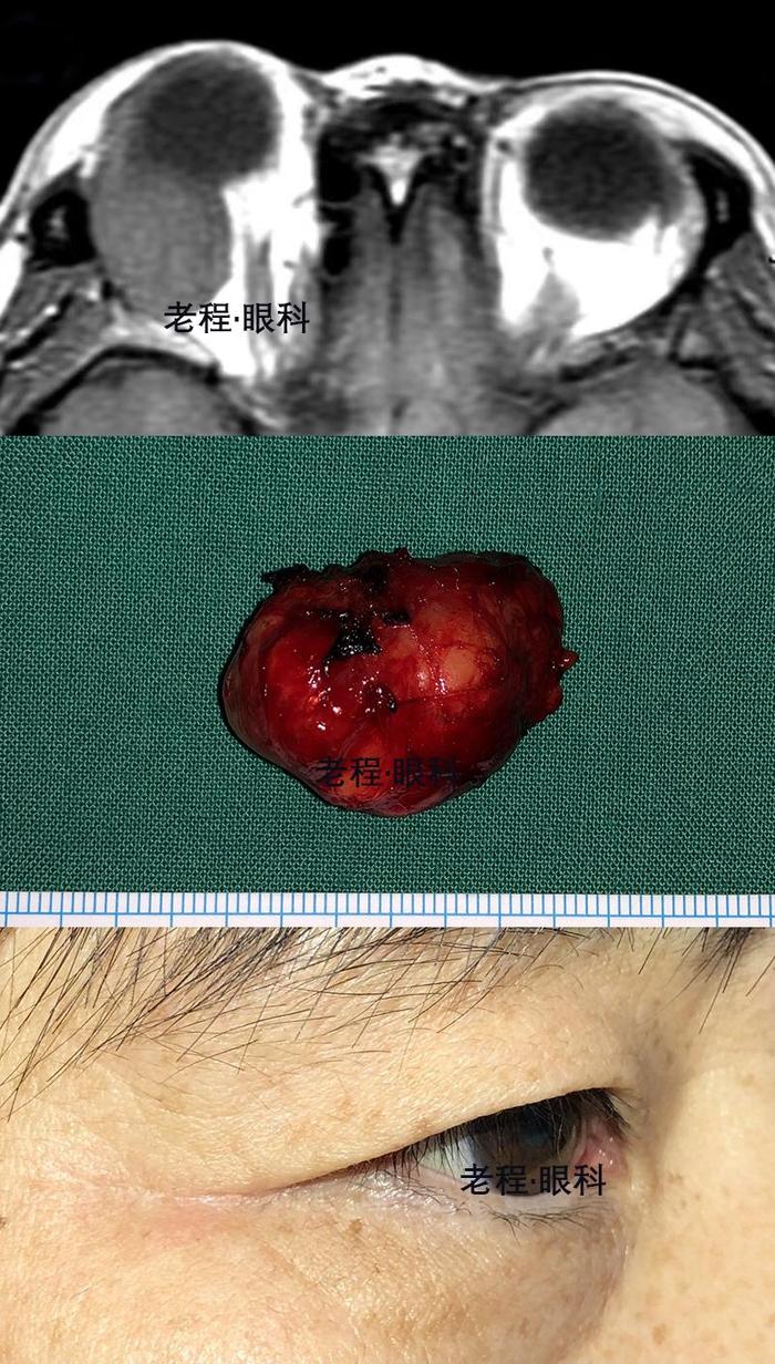 眼眶肿瘤不可怕,个性化手术有妙招! - 微医(挂号网)