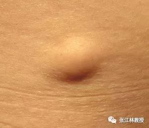 皮脂腺囊肿通常充满白色角蛋白碎片,这也是构成您的皮肤和指甲的主要