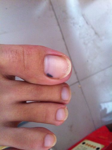 甲下变黑是恶性黑色素瘤吗