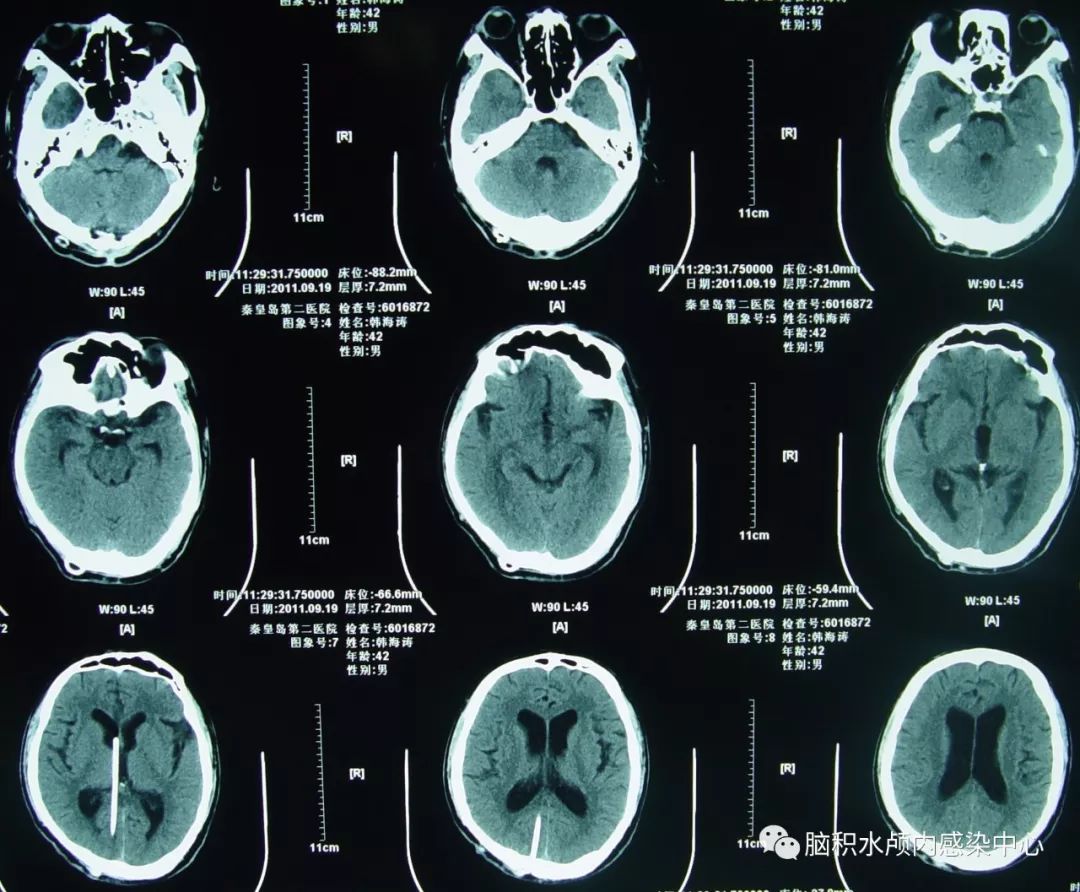 脑脊液科治愈一例小脑扁桃体下疝脊髓空洞枕下减压术后假性.