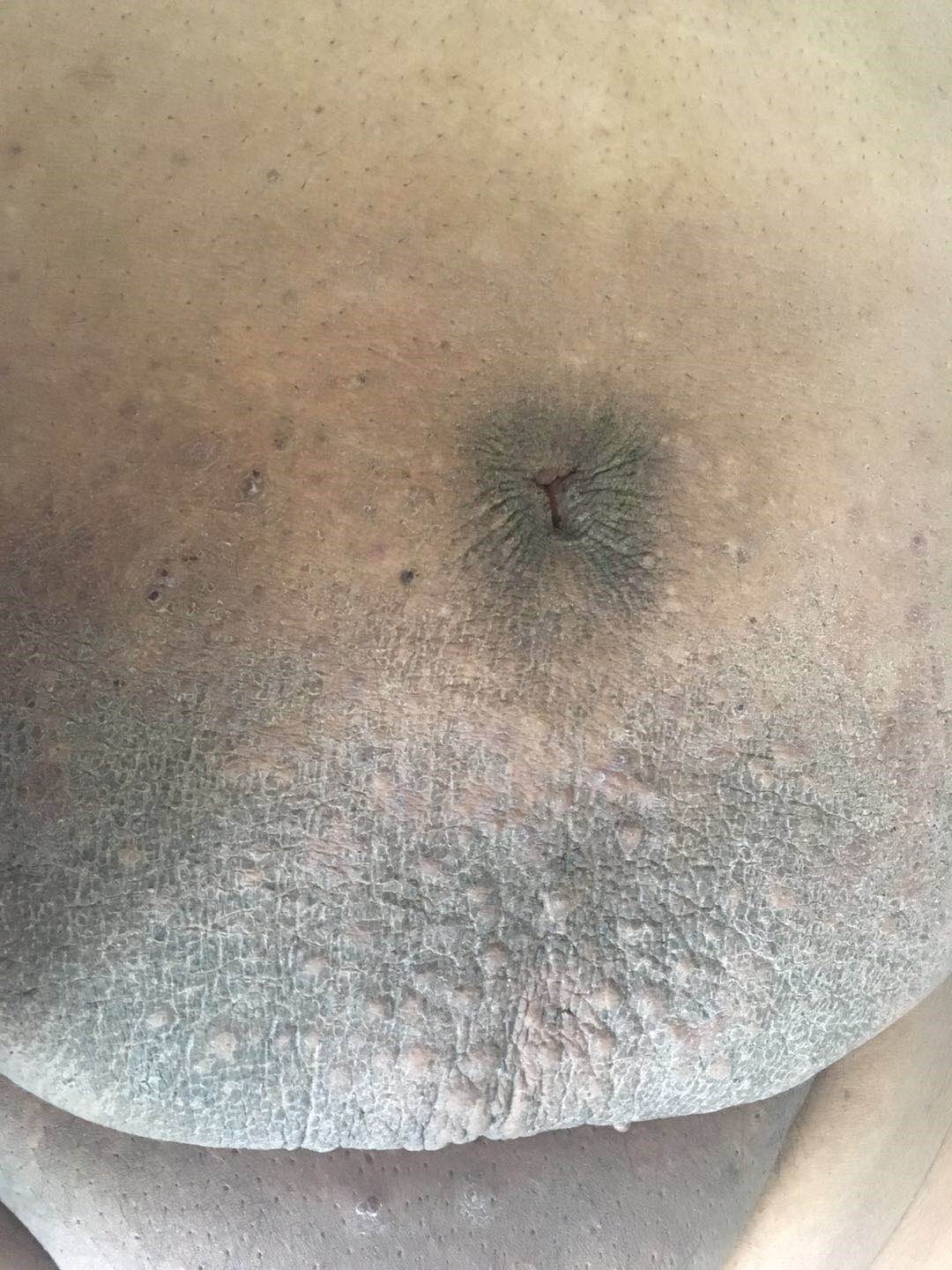 540斤重磅小伙来减重天津医科大学总医院减重专家团队