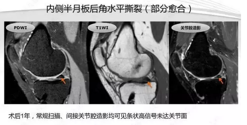 半月板 半月板损伤的mri诊断 健康号 微医