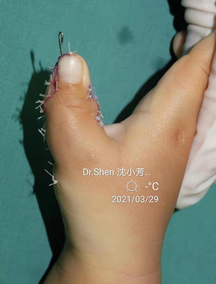蟹钳多指