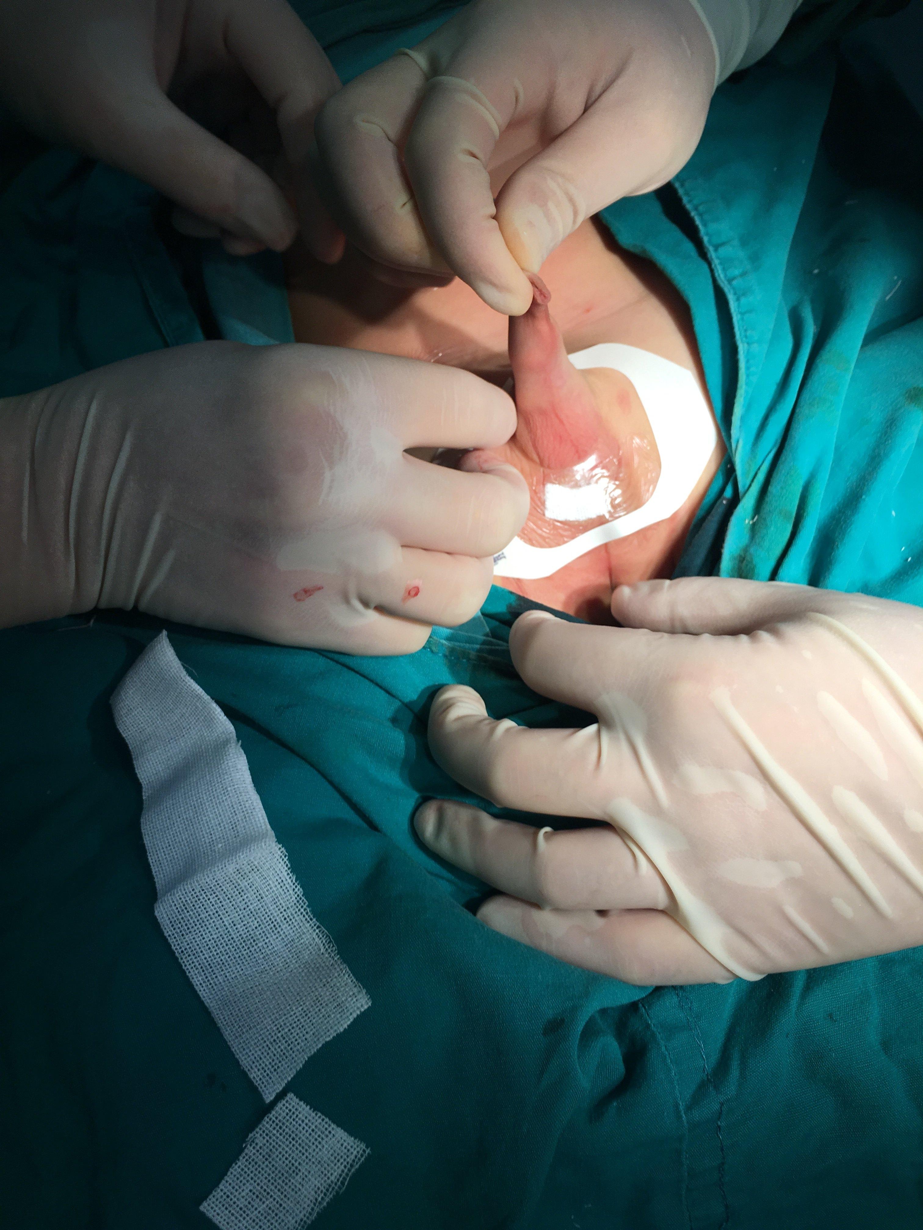 隐睾术后阴囊伤口换药指引