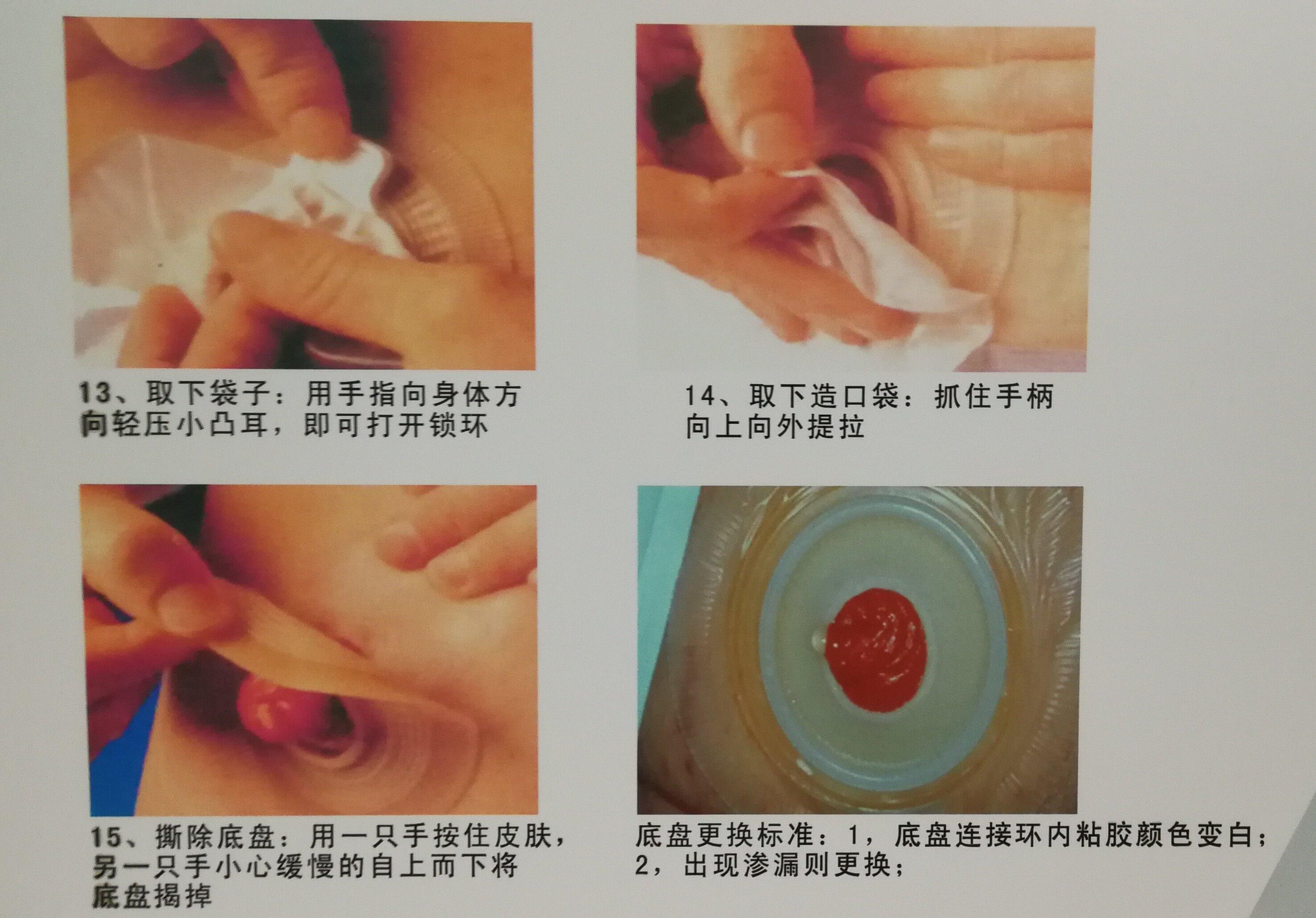 6. 在造口粘膜周围涂抹防漏膏