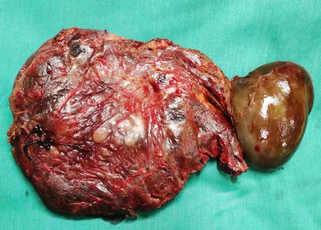 腹腔镜剥除手术治疗肝脏巨大血管瘤