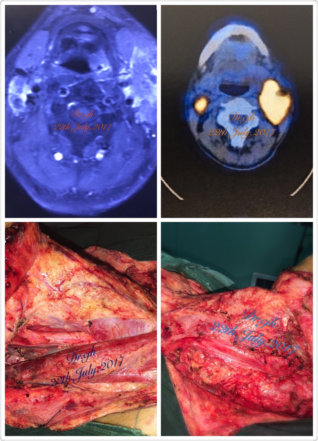 下咽癌诊治体会