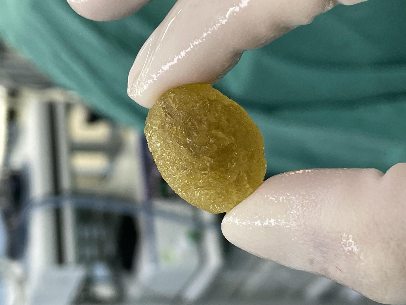 这种像蜜蜡一样的胆结石就是胆固醇性的结石,过饱和胆汁是胆固醇结石