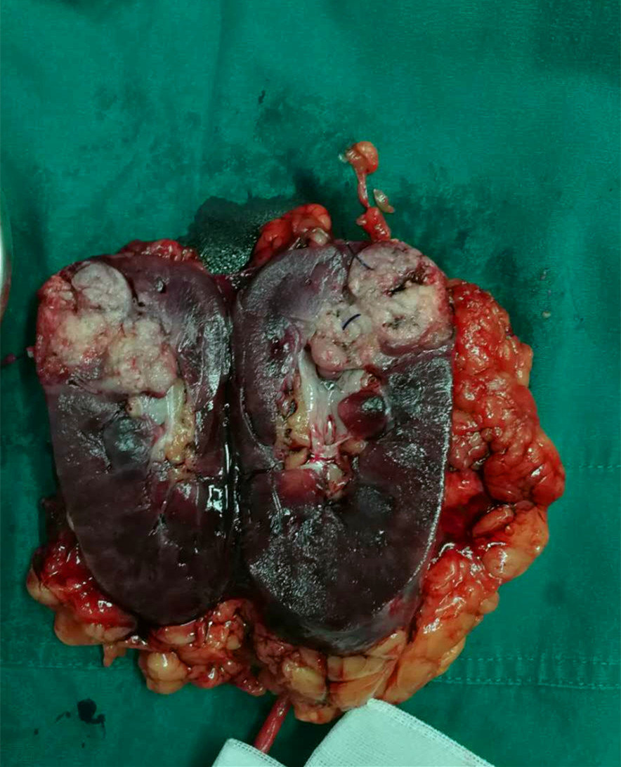 乳头状肾细胞癌,透明细胞癌,双侧肾癌的微创治疗进展