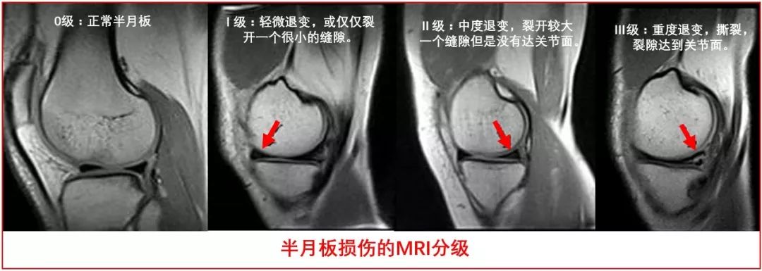 Ⅲ,vi度损伤,半月板撕裂性损伤慢性期症状不明显可保守治疗,症状