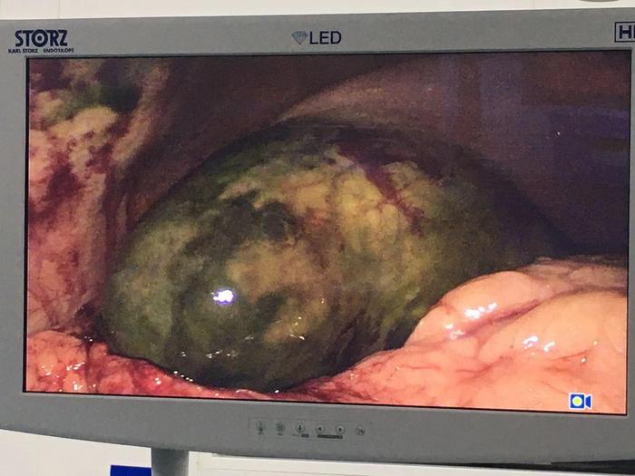 回盲部升结肠憩室炎穿孔伴脓肿形成坏死性胆囊炎急性粒细胞白血病