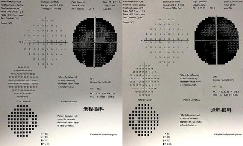 甲亢突眼之挽救视力性眼眶减压手术 健康号 微医